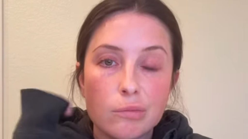 Bristol Palin struck by facial paralysis from neurological disorder