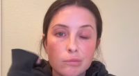 Bristol Palin struck by facial paralysis from neurological disorder