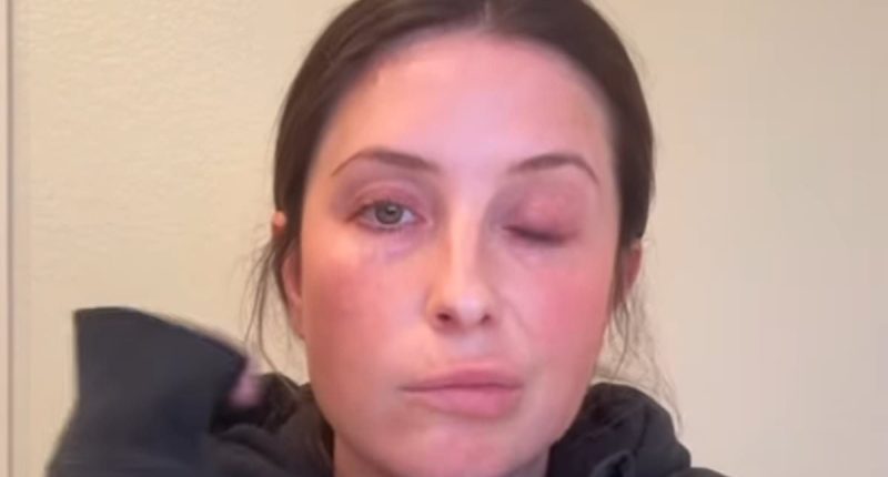 Bristol Palin struck by facial paralysis from neurological disorder