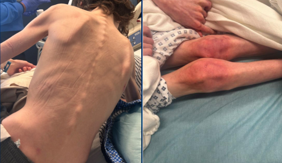 Mother, Stepfather Charged After Twin Teens Found ‘Malnourished and Extremely Thin’