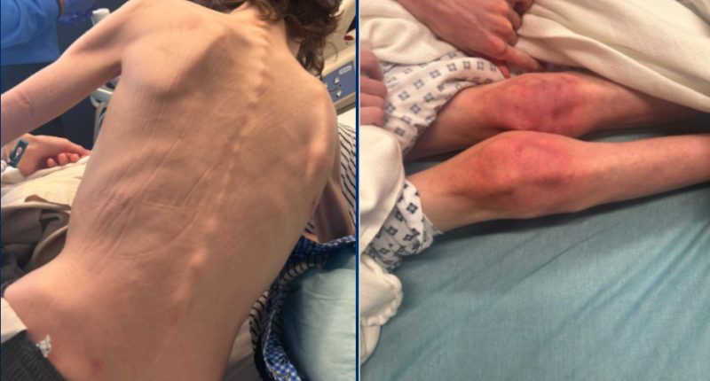 Mother, Stepfather Charged After Twin Teens Found ‘Malnourished and Extremely Thin’