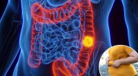 New study uncovers the biggest risk factor for colon cancer in under 35s — and it will shock you