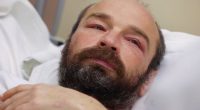 Man with swollen eyes lying in bed.
