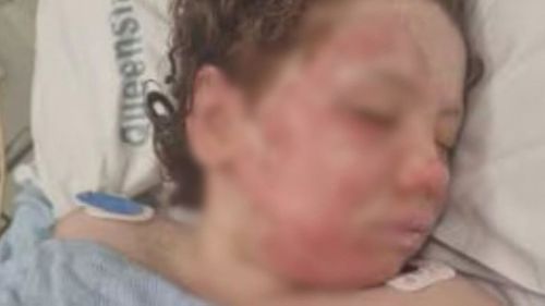 'Skin just falling off her': Girl left with burns after Temu jumper ignited 
An eight-year-old girl has been left with horrific burns after her jumper ignited while she was standing near a fire pit outside her home.