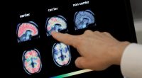 Dementia cases in the US projected to double by 2060