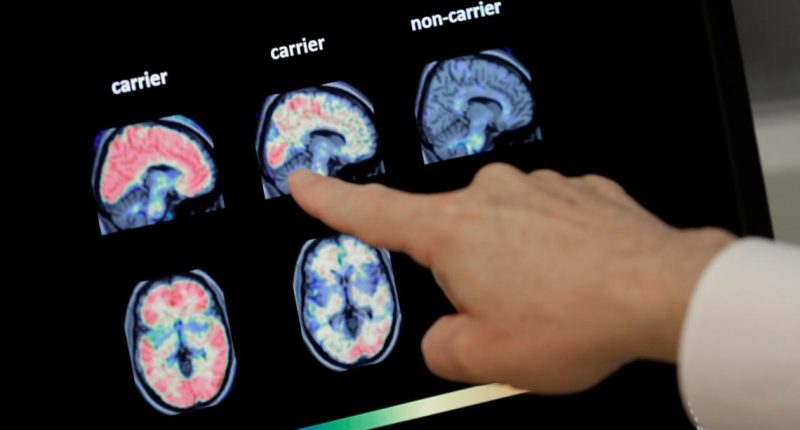 Dementia cases in the US projected to double by 2060