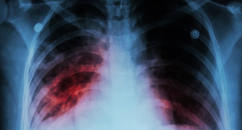 Kansas faces largest tuberculosis outbreak in state's history
