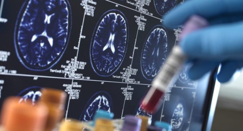 Self administered test boosts early diagnosis of cognitive disorders