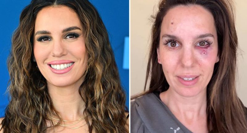 Christy Carlson Romano 'shot in the eye' during clay pigeon shooting outing with her husband for his birthday