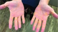 Extreme Carnivore Diet Led to Lesions: Man Develops "Cholesterol Hands"