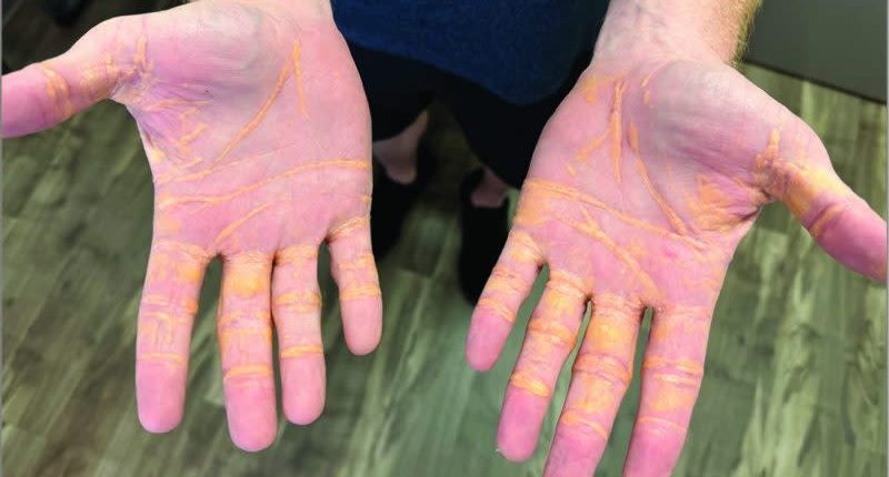 Extreme Carnivore Diet Led to Lesions: Man Develops "Cholesterol Hands"