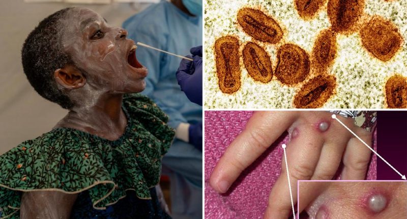 New mpox strain confirmed in NY for the first time