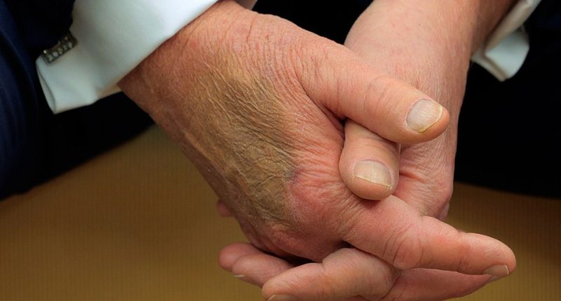 Close-up of hands with makeup covering a bruise.