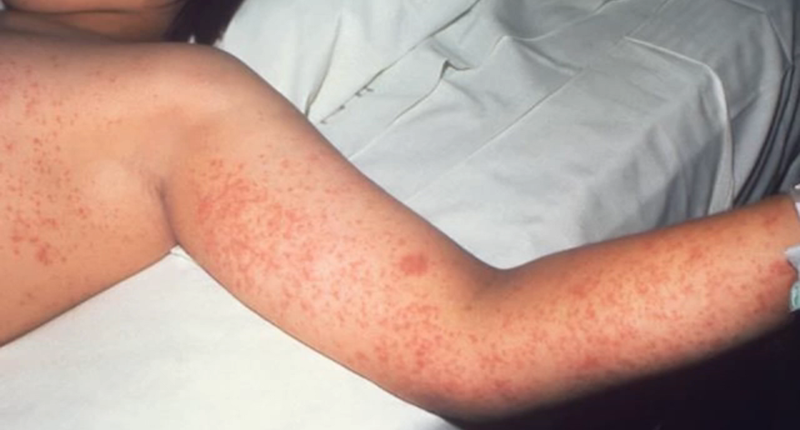 First measles death is reported in the West Texas outbreak that's infected more than 120 people