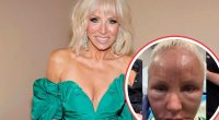 RHONJ Margaret Josephs Shows Before & After Pics of CO2 Laser