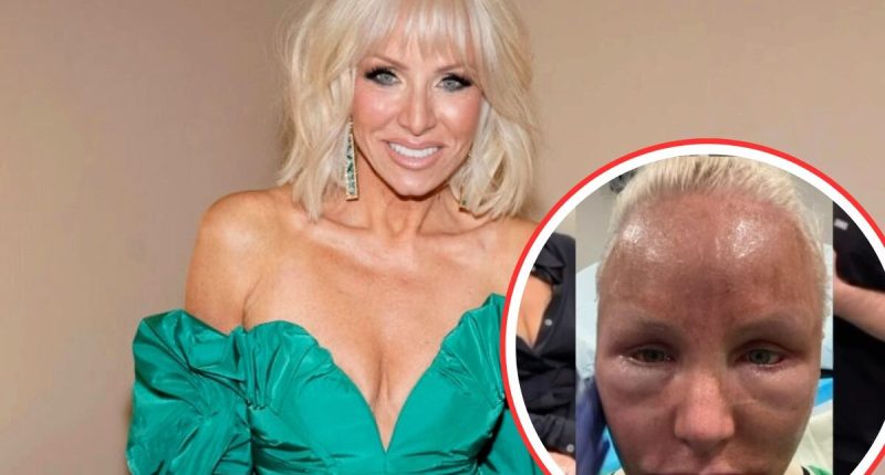RHONJ Margaret Josephs Shows Before & After Pics of CO2 Laser