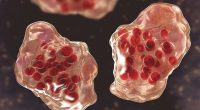 'Like a forest fire': Where large measles outbreaks will occur, according to an epidemiologist