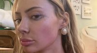 Close-up of Bri Stern showing bruises.