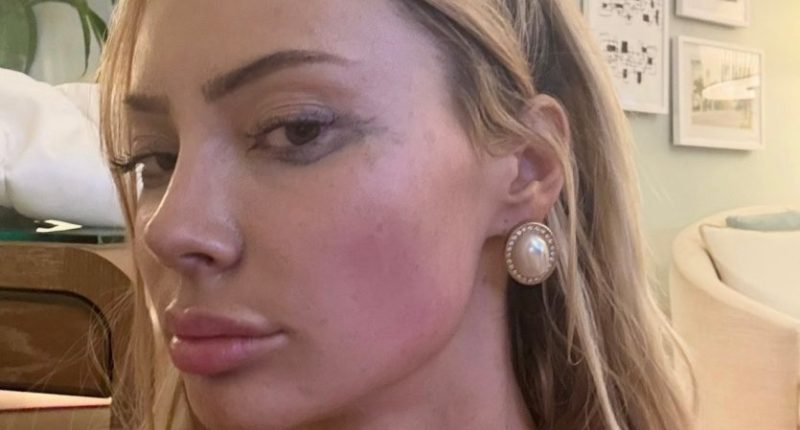 Close-up of Bri Stern showing bruises.