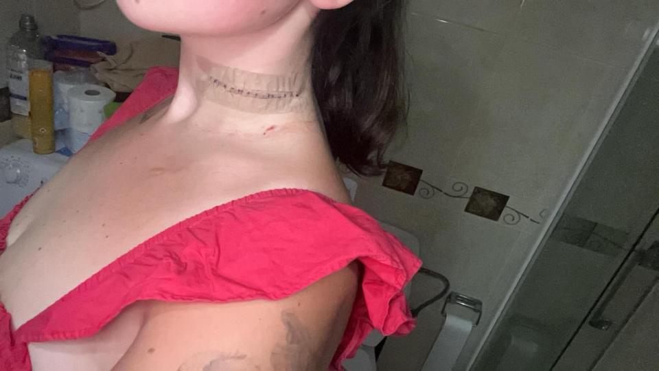 Woman's neck with stitches and a bandage.