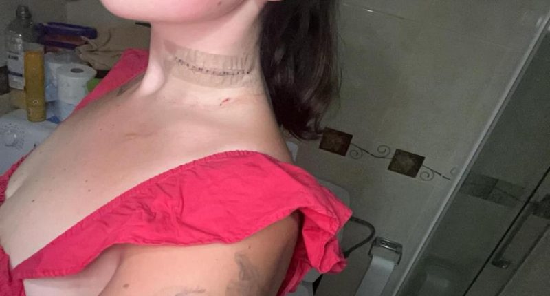 Woman's neck with stitches and a bandage.