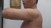Man with surgical scar on his torso.