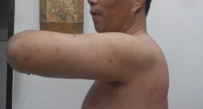 Man with surgical scar on his torso.