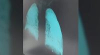 X-ray of lungs showing chemical pneumonitis.