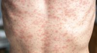 'Disappointed but not surprised': Measles cases explode in 19 states, new outbreak confirmed