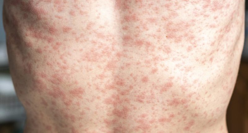 'Disappointed but not surprised': Measles cases explode in 19 states, new outbreak confirmed