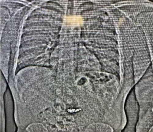 This image provided by the Orlando Police Department shows an x-ray of what are believed to be two diamond earrings that were stolen from a Tiffany & Co. jewelry store in central Florida and were swallowed by the suspect. ( Orlando Police Department office via AP)