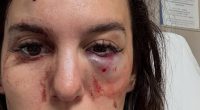 Disney star reveals horrific eye injury after getting shot saying she almost went BLIND and has lead stuck in her skull