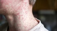 Measles cases more than double in Kansas