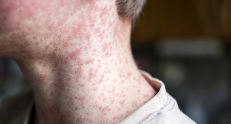 Measles cases more than double in Kansas
