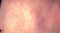 Measles cases reach nearly 300 total in Texas and New Mexico. Here's what you should know