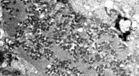 Patient dies after getting rabies from organ transplant
