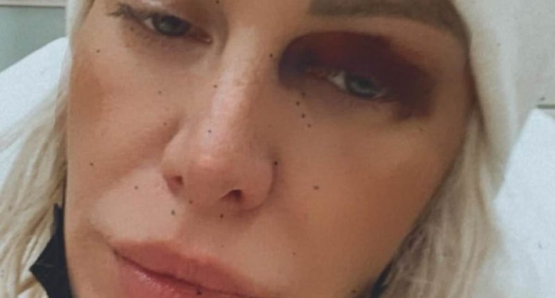 Reality star unrecognizable in shocking bruised snaps