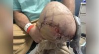 Amputated leg