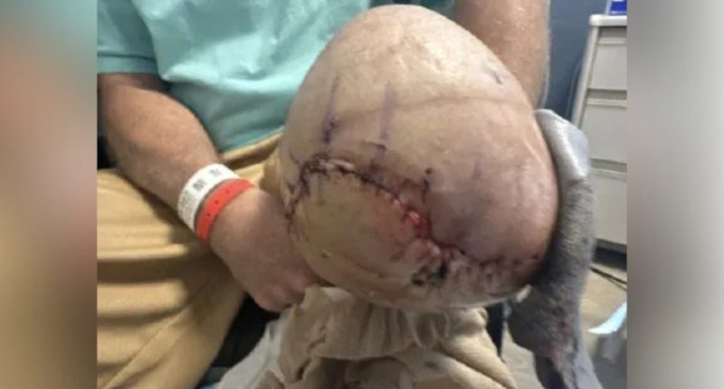 Amputated leg