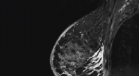 Biopsy mix up