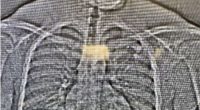 This image provided by the Orlando Police Department shows an x-ray of what are believed to be two diamond earrings that were stolen from a Tiffany & Co. jewelry store in central Florida and were swallowed by the suspect. ( Orlando Police Department office via AP)