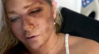 Woman in hospital bed with facial injuries.