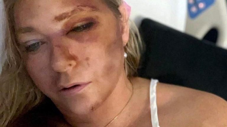 Woman in hospital bed with facial injuries.