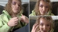 Long Island girl mauled by neighbor's pitbull