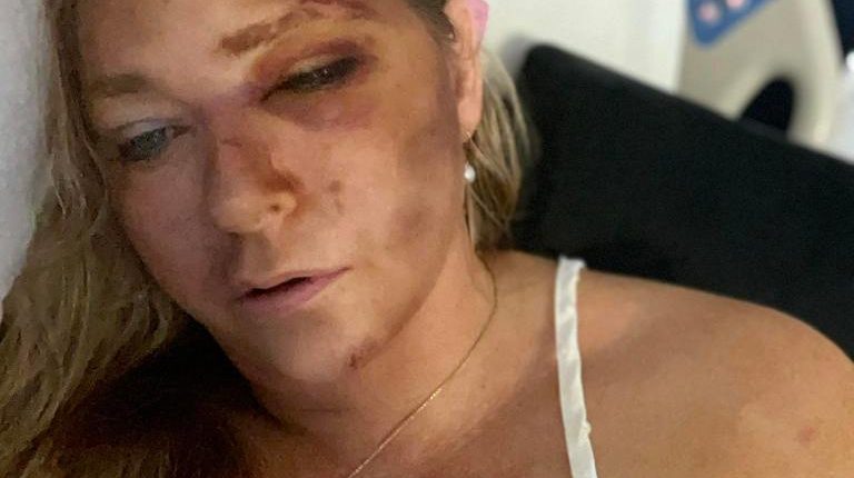 Woman in hospital bed with facial injuries.