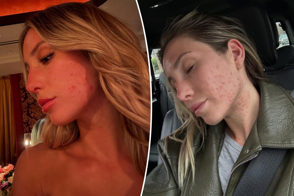 ‘Petrified’ Alix Earle ditches makeup in public for first time amid ‘blistering’ breakout