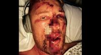 Andrew Flintoff's gruesome injuries from near-fatal Top Gear crash where he 'thought my face had come off' shown in grisly new photos from his Disney documentary