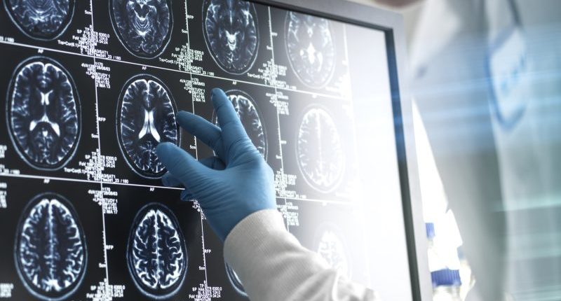 What to do and not do if someone is having a stroke