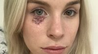 I thought the spot under my eye was a blocked pore, it was cancer