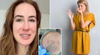 I've had a 7-year infection since my ex farted in my face